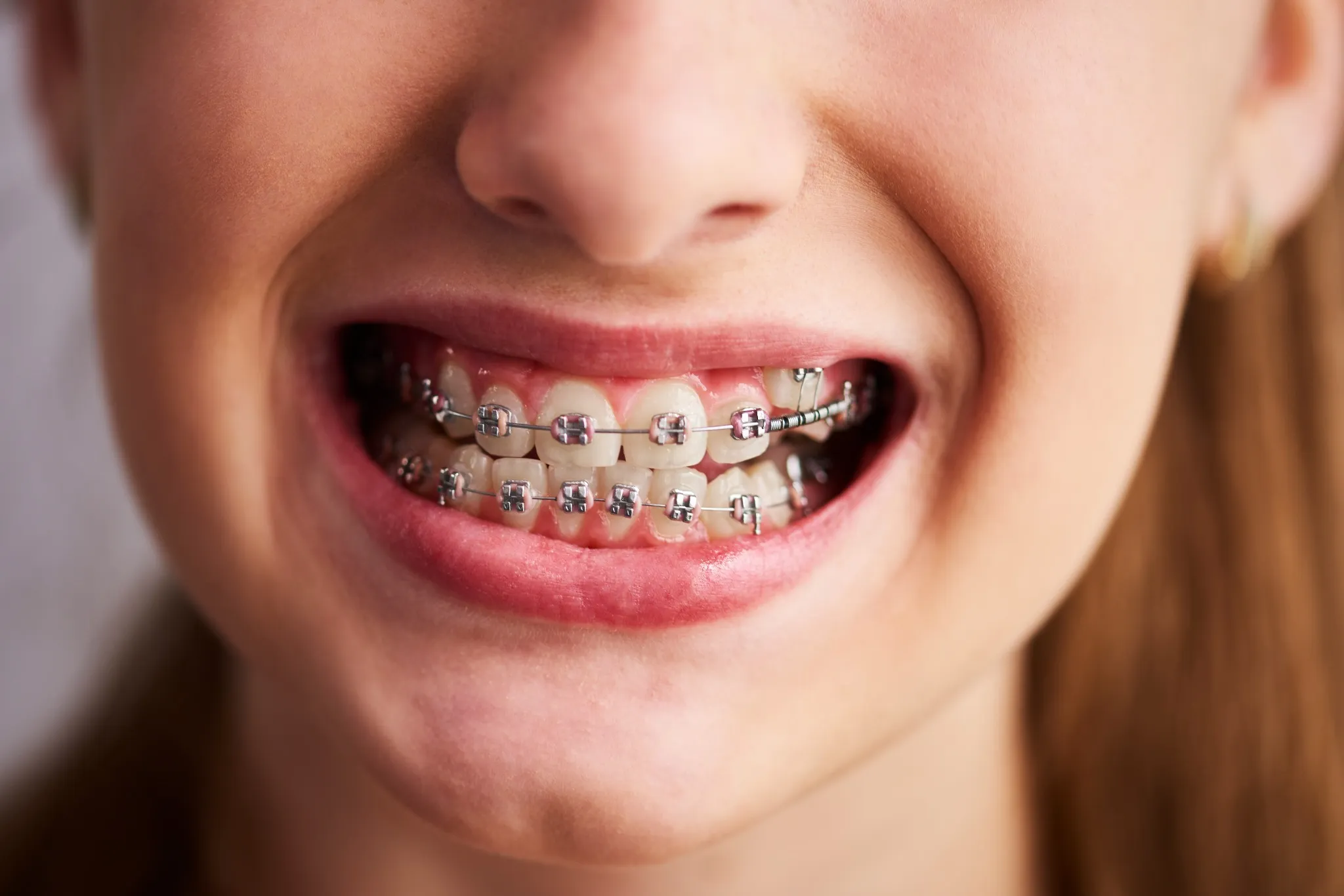 Emergency dentist treating Orthodontic Injury in Fairfield, CA