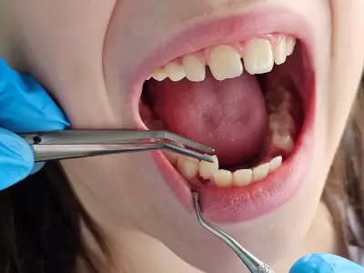 Patient biting gauze for bleeding extraction site care in Fairfield CA
