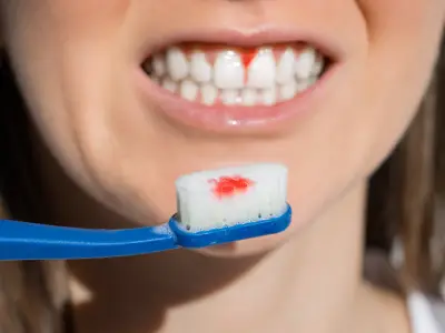 Inflamed bleeding gums needing periodontal care in Fairfield CA