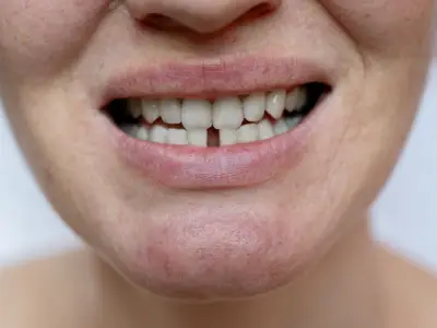 Patient with broken chipped tooth needing same-day repair in Fairfield CA