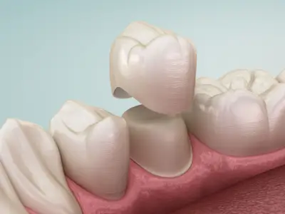 Lost dental crown needing same-day repair in Fairfield CA