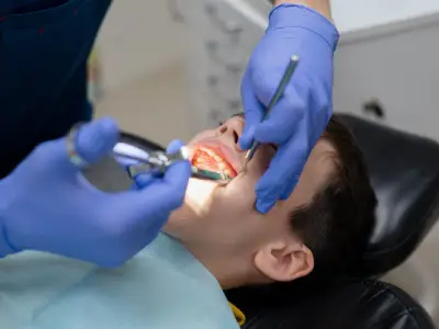 Wisdom Teeth Extraction Fairfield