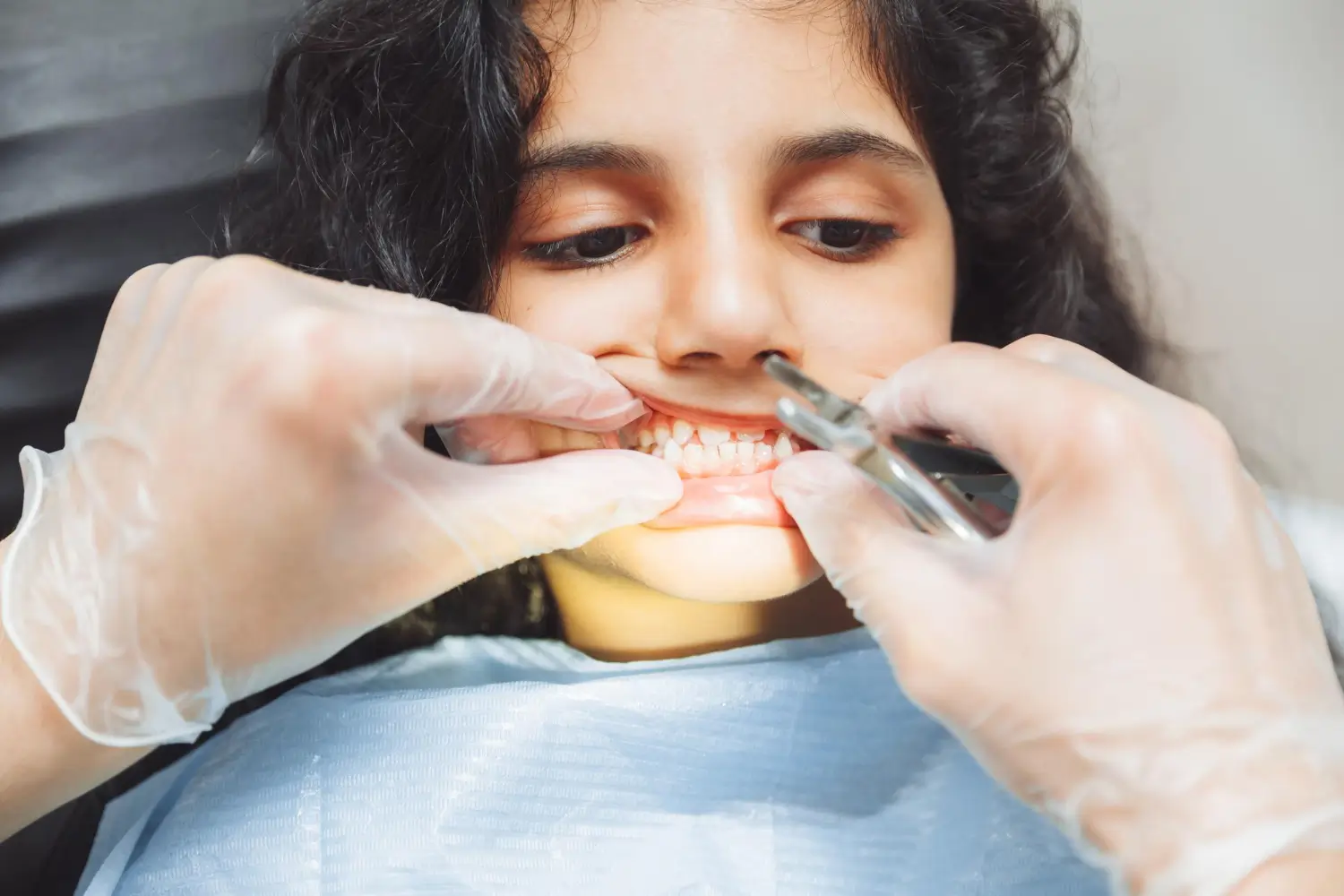 Emergency dentist treating Broken or Chipped Tooth in Fairfield, CA